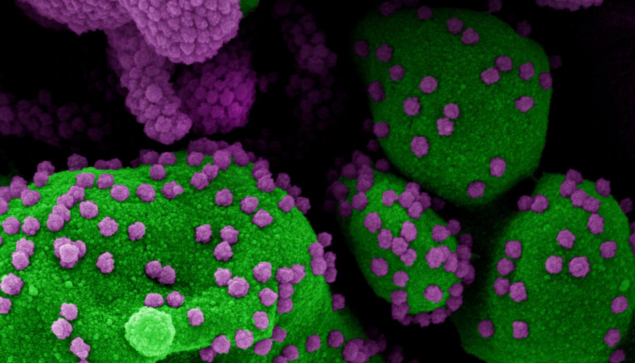 SARS-CoV-2 viiruse osakestega (lilla) tugevalt nakatunud apoptootilise rakk (roheline)