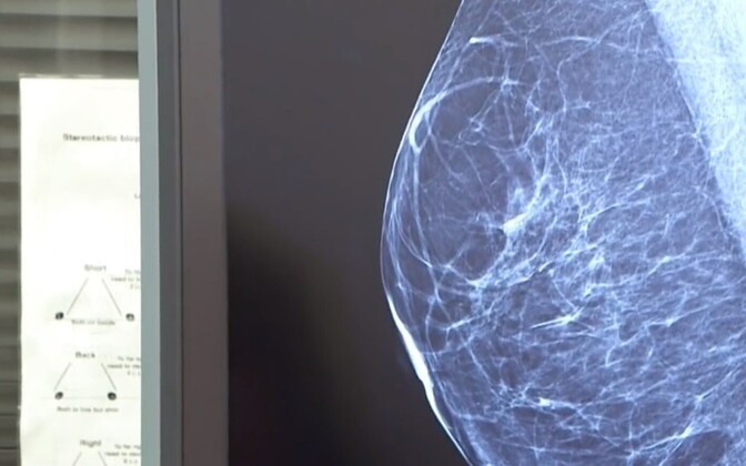 Infosüsteemide probleemid ei võimalda ise sõeluuringule aega broneerida