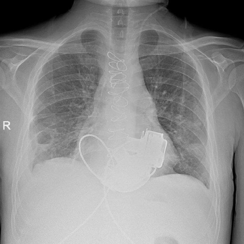 Главное за ночь: в России выписан пациент без пульса, а в США 100 машин столкнулись в снег