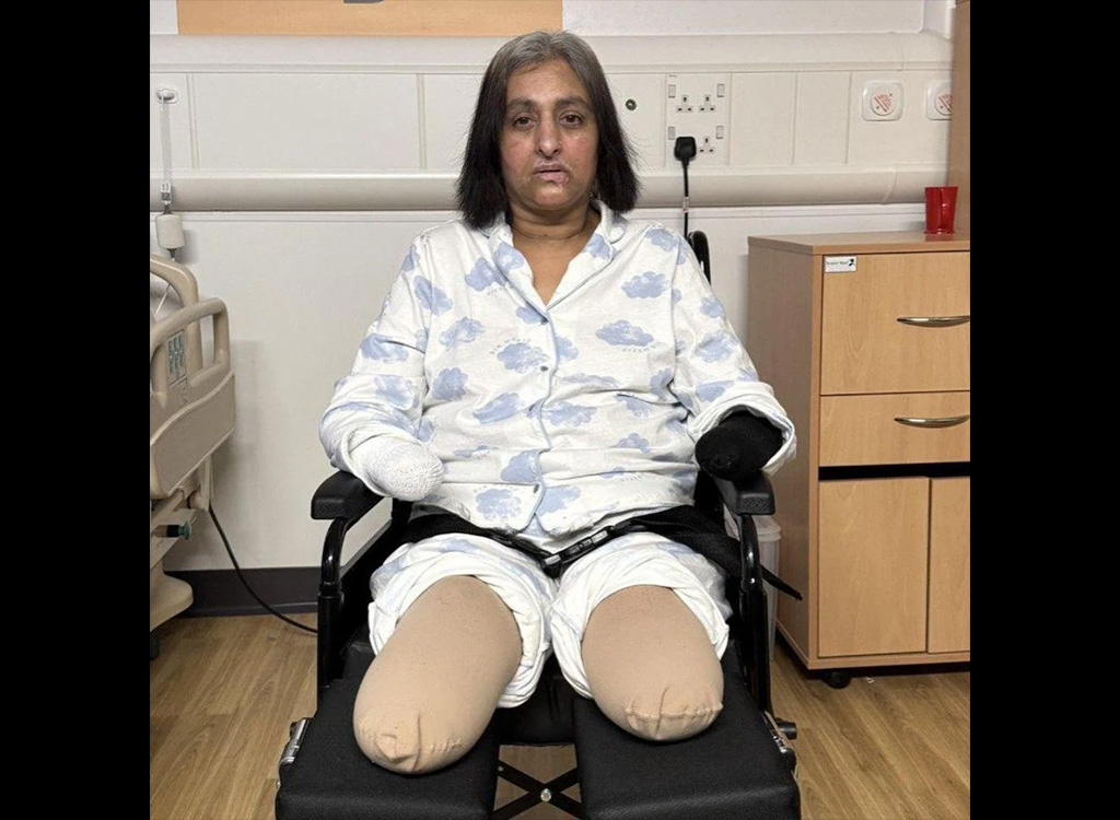 Hoiatav juhtum: naine kaotas kõik oma jäsemed pärast seda, kui lasi neid koeral lakkuda