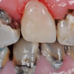 INIMKATSETE TULEMUS ⟩ Selle aminohappega saab võidelda hambaaukude ja kaariesega