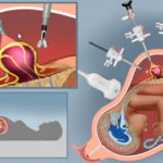 Tüvirakkudega raviti loode terveks surmavast tõevest – sündinud laps on igati terve
